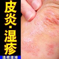 湿毒苗方皮肤止痒膏手脚过敏湿疹大腿内侧私处皮肤瘙痒乳膏