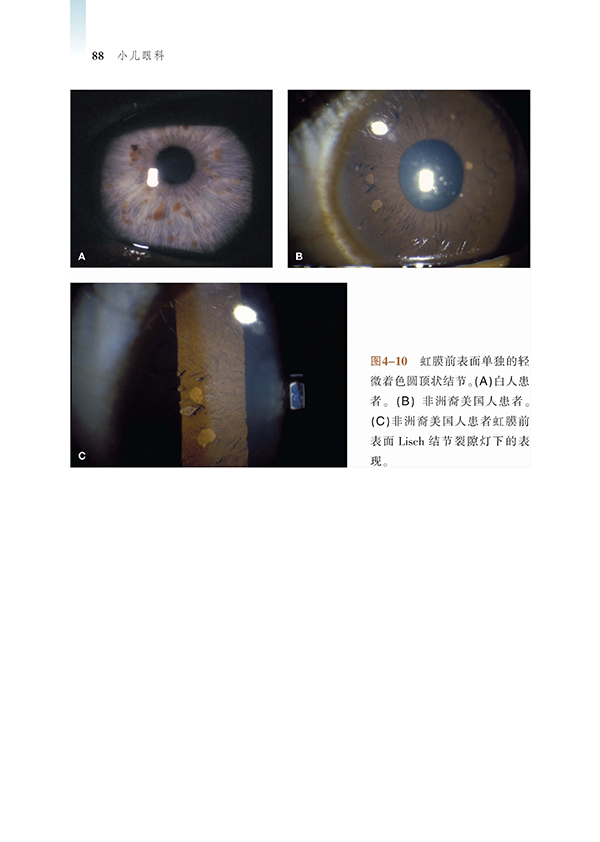 眼的整体畸形无眼畸形小眼畸形小眼球典型眼组织缺损第2章 先天性角膜