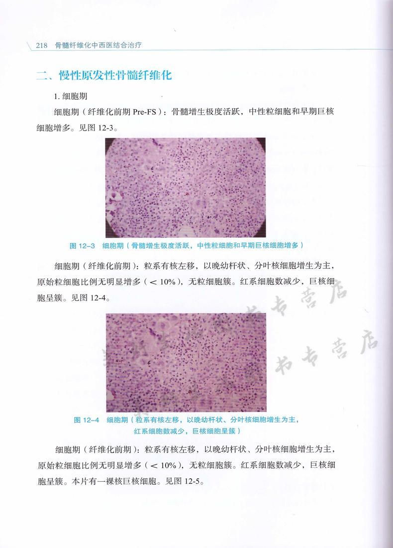 骨髓纤维化中西医结合冶疗