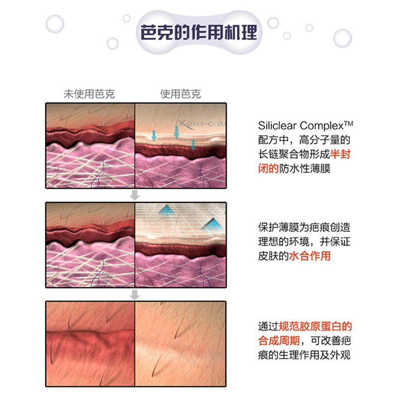 美国芭克 KELO-COTE 疤克凝胶软膏去疤修复膏 15克 儿童剖腹产 双眼皮手术 烧伤烫伤淡疤护理液