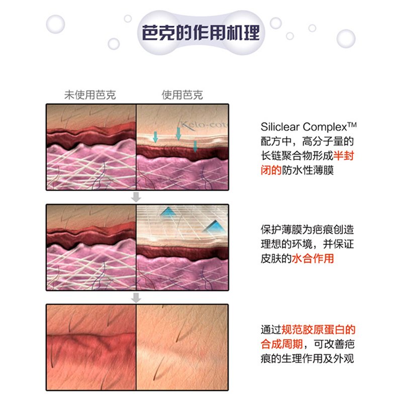 芭克 KELO-COTE 疤克凝胶软膏去疤修复膏 15克 儿童剖腹产 双眼皮手术 烧伤烫伤