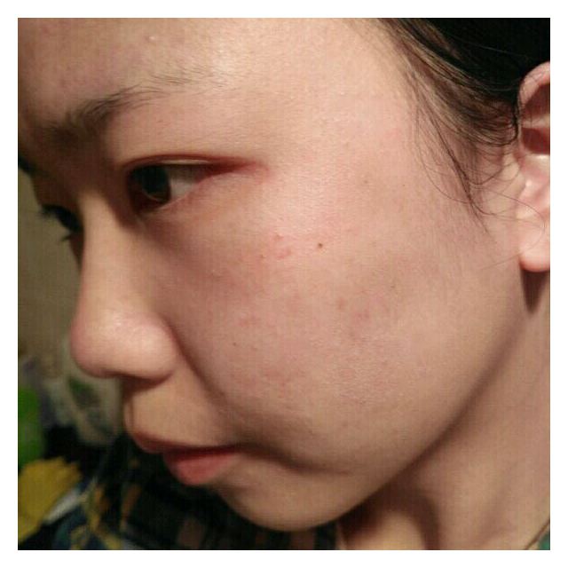 芷轩堂男女士无痕祛痘印淡化精华 草本修护去痘印产品祛痘疤膏凹洞