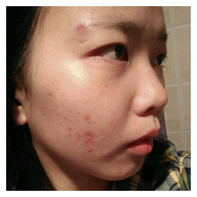 芷轩堂男女士无痕祛痘印淡化精华 草本修护去痘印产品祛痘疤膏凹洞