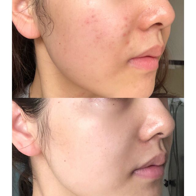 花叶子茶树bl精油20ml澳洲茶树精油面部祛痘痘印植物精油粉刺脸部控油