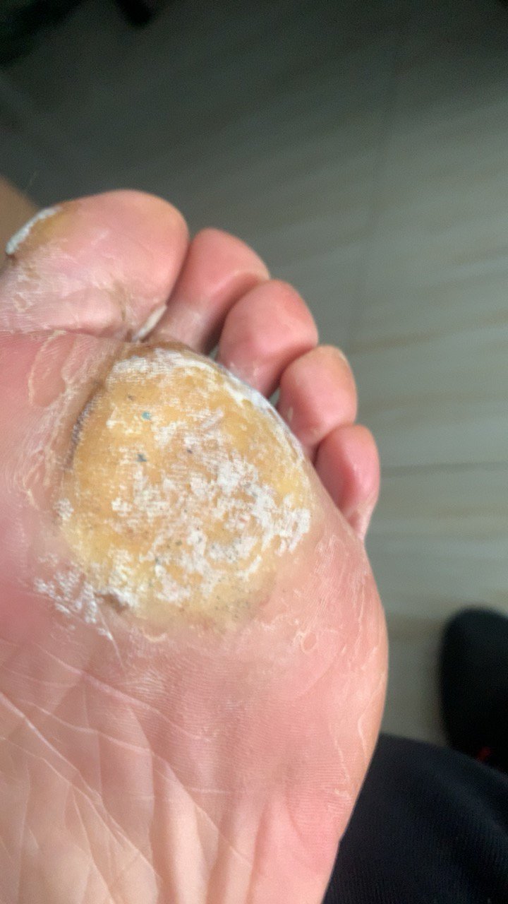 【买2发3盒】脚医生正品消茧灵去除脚底上老茧脚垫净厚茧胼胝角质死皮