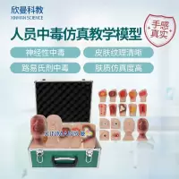 欣曼科教 人员中毒仿真模型 神经性中毒 芥子气中毒 路易氏剂中毒 教学用模型XM-SQ16A
