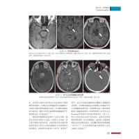 成人中枢神经系统肿瘤放射治疗学:从理论到实践 