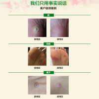 滴疣芬去疣溶液15ml Duofilm施泰福 清楚赘疣 瘊子 防水 无腐蚀【海外购 澳洲直邮】