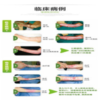 法国优格 优拓SSD 磺胺嘧啶银脂质水胶敷料 10cm*12cm/片 2度烧伤