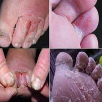 买一送一足立清泡脚液治脚气脚臭脚汗脚痒烂脚丫脱皮泡珊瑚癣净