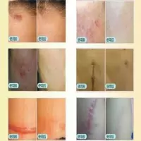 疤痕克星蜂胶去疤痕肥胖纹烫伤痘印手术疤妊娠剖腹疤凹凸疤均可用