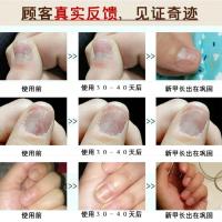 [新配方套装]去除灰指甲新亮甲液修甲灰指甲增厚去灰甲清软甲膏