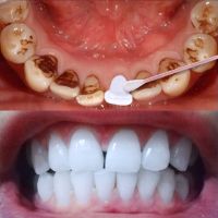 [一擦就白]牙齿速效去除去牙烟牙菌斑牙垢洗牙粉液牙斑净