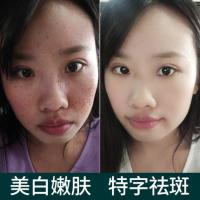 正品祛斑霜老中医雀斑色斑去晒斑褐斑老年祛斑产品男女