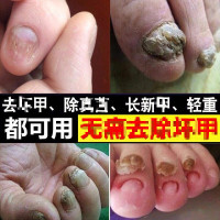 [灰甲专家]针对顽固型灰指甲非药灰指甲水不包扎不修甲30ml 精选特买