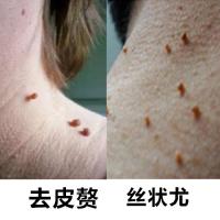同款电视专营去除面部扁平疣丝状疣脖子颈部肉粒疙瘩皮赘膏液治肉刺瘊子的