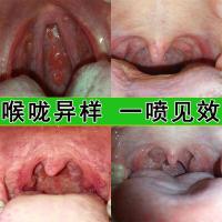 急慢性咽炎咽喉炎特傚蜂胶喷剂异物感干痒咳肿痛滤泡