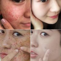 嫣植祛痘苗嫣植本然堂美妮祛痘翠芙兰百达祛痘印痘疤清颜春天祛痘液搽剂