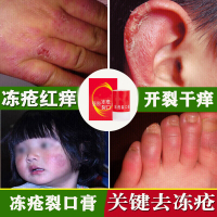 冻疮膏消肿止痒儿童成人防手裂膏足霜宝宝脸部防冻伤膏开裂皲裂膏保湿护手霜脱皮脚跟干裂护脚霜冬季防冻