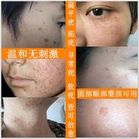 扁平疣去除膏面部肉痣凸痣寻常疣去疣灵肉粒丝状瘊子跖疣