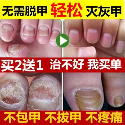 简大夫液灰指甲专用液亮甲真菌感染里素劳酮康唑片真菌感染