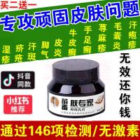 好店精选汗斑的药毛囊炎荨麻疹断根外用药牛皮癣湿疹皮炎止痒去根汗斑专用药膏