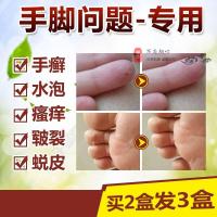 汗疱疹手痒起小水泡治脚痒水泡止痒膏脱皮烂脚丫成人掌平