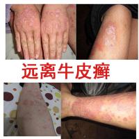 专治牛皮藓银鲜牛皮藓专用用药膏股体廯紫椒癣酊恩孝堂外用