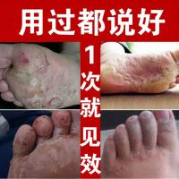 去角质牛皮老皮脱皮 浓苯甲酸去角质软膏
