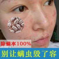 出螨虫的香皂出螨皂虫神器脸部 清洁 面部背上背后脸上胸前祛痘控油洗脸