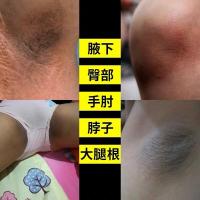 去黑色素沉淀脸去黑色素沉淀黑脖子腋窝大腿内侧根部腋下颈部脸部保湿霜嘴角