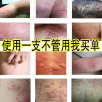 宛伊蛇由抑菌宛本蛇油膏由膏蛇护手霜伊依本止痒克座隐酮乳膏百止痒