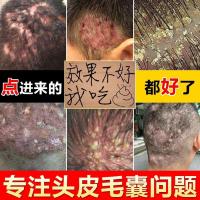 毛囊炎洗发水头皮护理毛囊洗炎去螨虫洗发水露搭专用去屑止痒深层清理2瓶价 洗发水+止痒膏 其他/other