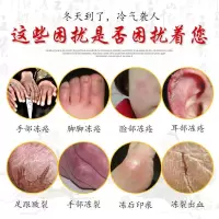 治根消肿止痒冻伤手足耳朵红肿防冻防裂一抹消冻必治手部