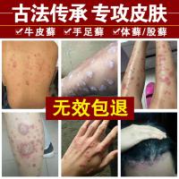 牛皮癣专用药牛皮止痒皮肤外用专用特傚股藓瘙痒銀屑病鲜蘚癣銀屑湿疹药膏