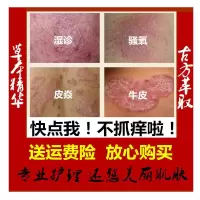 紫椒癣酊銀屑癣奇痒王头皮癣药膏外用银屑藓全身皮肤瘙痒手脚老偏方止痒乳膏