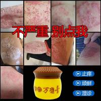 万应膏本膏牛癬大腿内侧屁股湿痒手足头皮顽固囊痒成人