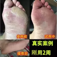 牛皮癣 进口泰国进口皮肤牛皮癣手足癣外用膏真菌病效止痒瘙痒廯藓鲜