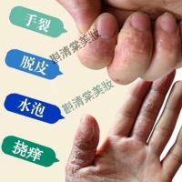 专营店独秘珍宝独秘珍宝手痒水泡脱皮干裂止癢膏手上起皮干燥肤专家软膏专柜