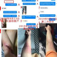 仁和膏去疤痕修复儿童烫伤去除痘印凹凸手术疤痕灵贴凝胶