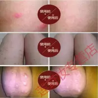 疥清抑菌液荣福堂疥清液 疥瘡去虱螨虫湿虱疥虫止痒拍2发3
