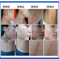 邦美施玛卡天赐疤痕凹凸伤疤痘印痘坑马卡玛咖天刺纯凝胶