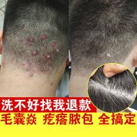 [优先发货]头皮毛囊焱炎脂溢性皮炎洗发水去屑止痒红斑痛脓包疙瘩抠颗粒专用