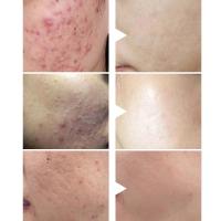 草本祛痘霜 闭口青春痘粉刺植物萃取温和祛痘膏