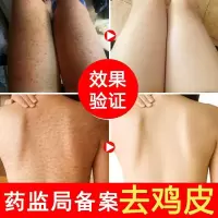 去鸡皮肤鸡皮膏修护毛周身体霜祛鸡皮肤疙瘩角化滋润保湿身体乳