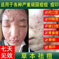 祛痘精华液痘印控油去粉刺青春痘暗疮紧致肌肤原液 直供