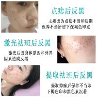 [中]院特号斑后控色霜不脱皮嫩白淡斑绿霜回流霜点斑点痣