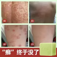 [新品]去癣净肤皂止痒去皮屑脱屑癣全身深层清洁香皂