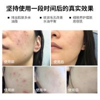 [新品]多重焕肤精华液祛痘修护痘印痘坑闭口粉刺精华院