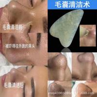 毛囊清洁霜1000g 院装毛囊清洁霜净化毛孔粉刺清洁术去黑头角质按摩膏源头